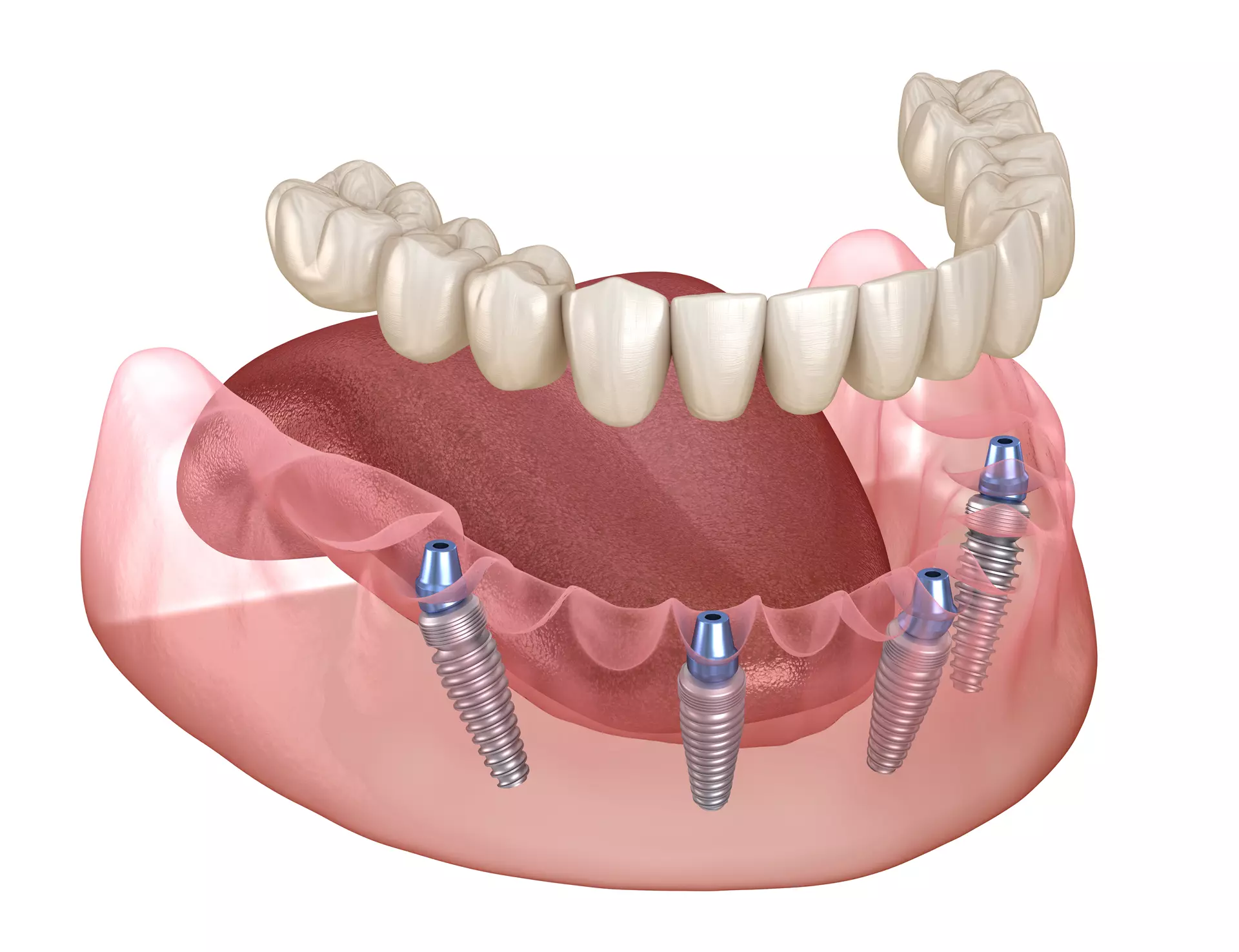 All-on-4 Dental Implants in Albuquerque