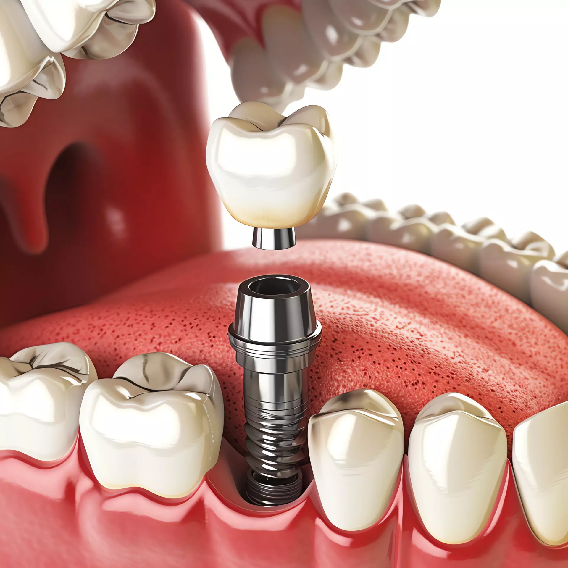 Dental Implants in Albuquerque